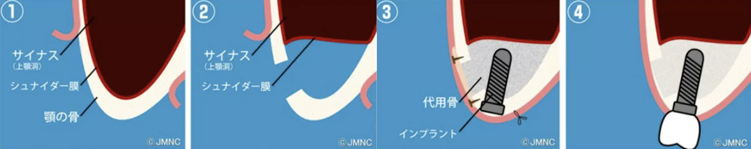 サイナスリフト