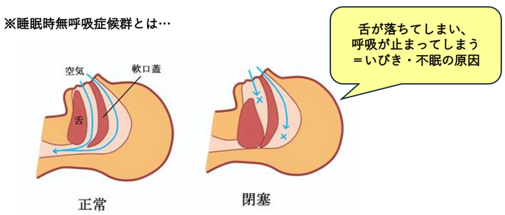 いびきの最大の原因は「舌の沈み込み」！！